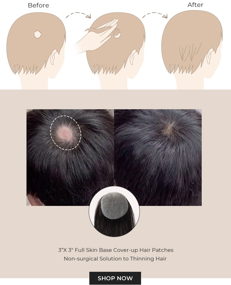 3”X 3” Full Skin Base Human Hair Cover-Up Hair Patches- No Surgical Solution For Alopecia Areata | 12”