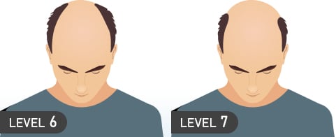 ADVANCED STAGE HAIR LOSS